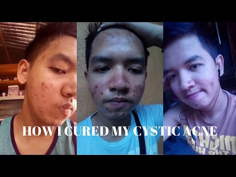 HOW I CURED MY CYSTIC ACNE. Very Affordable!