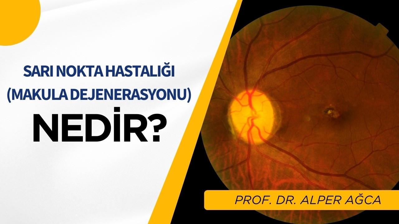 Sarı Nokta Hastalığı Nedir? / Prof. Dr. Alper Ağca