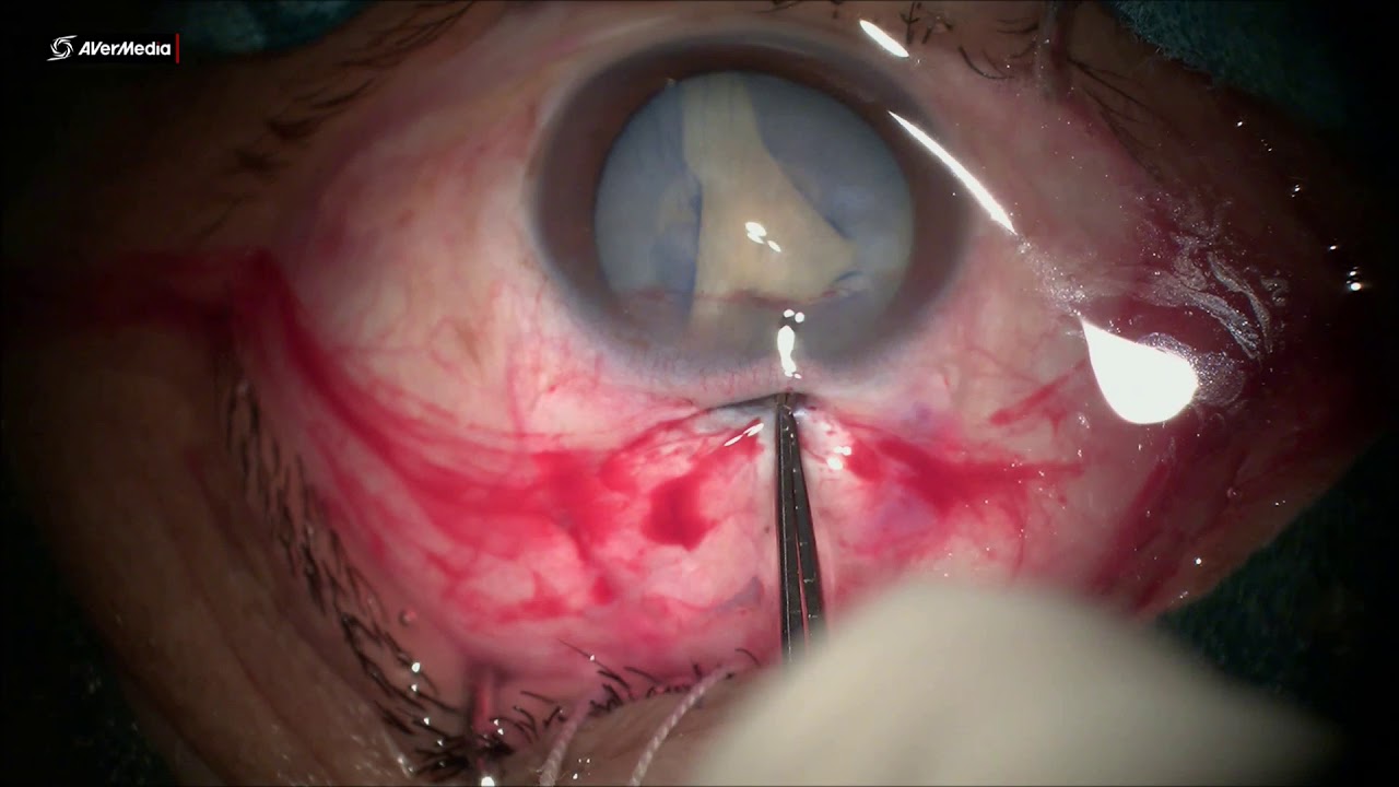 SICS in hypermature cataract with Argentinean flag sign by Dr.(Prof) Kamaljeet singh (Prayagraj)