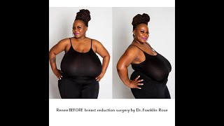 “Biggest Natural Breasts In Texas” Houston Breast Reduction Surgery 