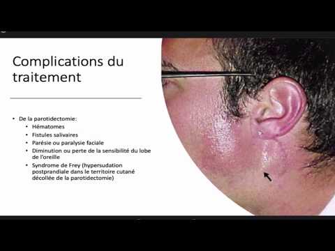 Vidéo: Aperçu De La Chirurgie Majeure Du Cancer Des Glandes Salivaires En Ontario (2003-2010)