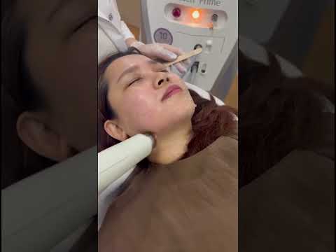 Accent Prime ilə üzün RF liftinqi
