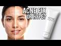 Aziderm 10% Cream Review | Honest Review for Acne, Acne Marks &amp; Pigmentation | Worth It or Not?