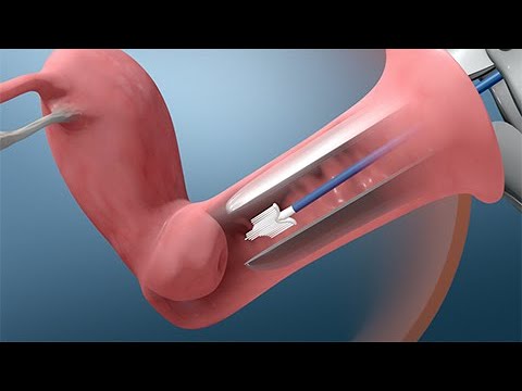 Video: 3 formas de realizar la prueba del VPH