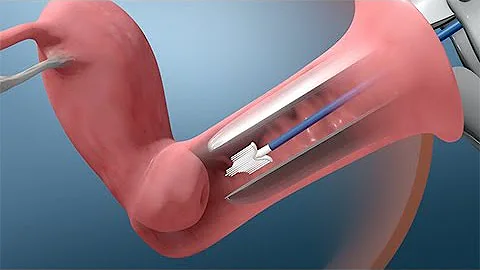 ¿Cómo se trata la citología vaginal positiva al VPH?