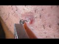 Plucking facial hair & ingrown hair 1007 頬髭抜き(埋没毛あり)