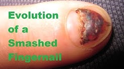 Evolution of a Smashed Fingernail