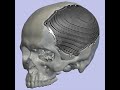 Cranial implant modeling using only freeware