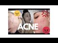 MILD TO SEVERE ACNE ROUTINE + PRODUCTS