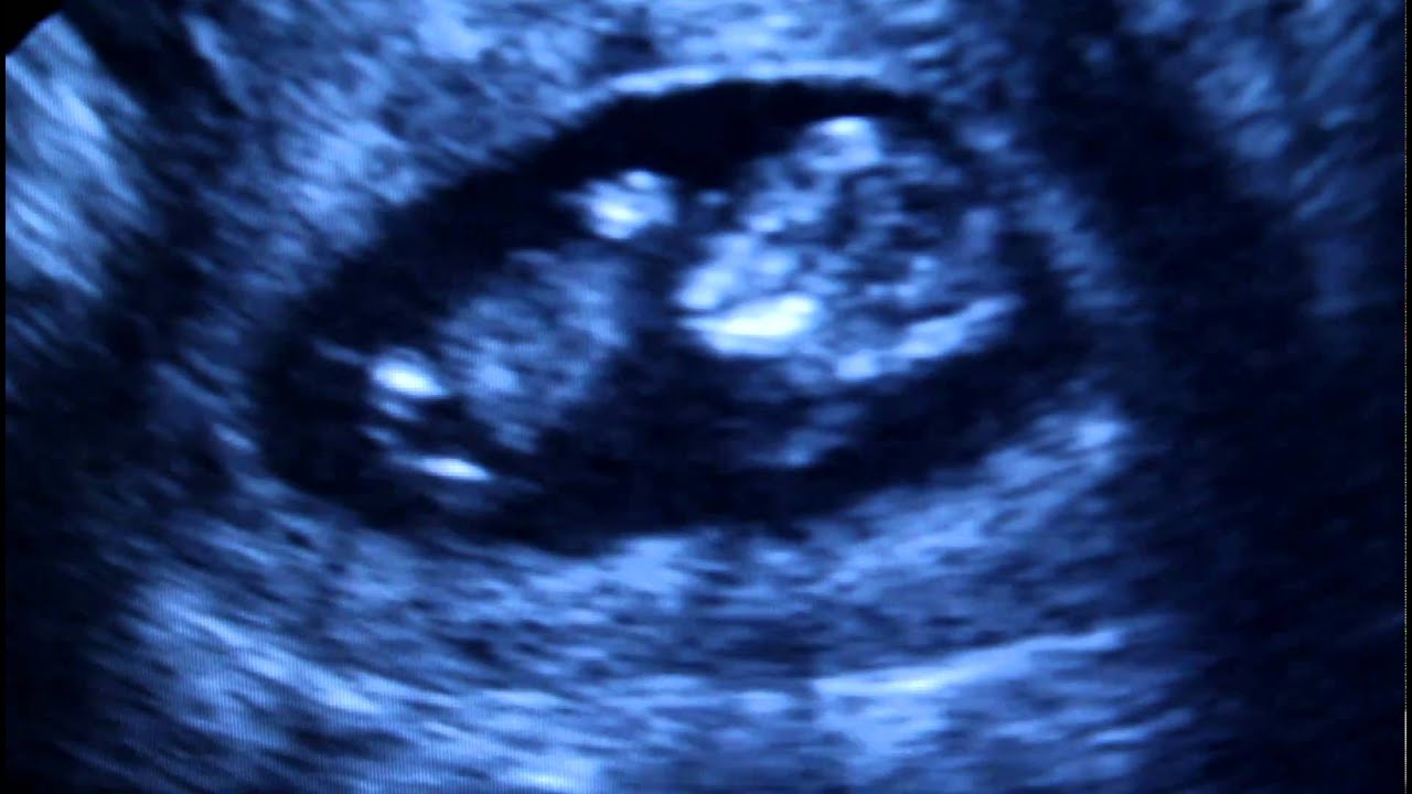Ultrasound Baby at 11 weeks and 2 Days 2 YouTube