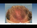 Hair Transplant Before and After: Bernstein Medical Patient ACM