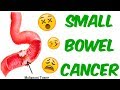 Intestinal Cancer (Small Bowel Adenocarcinomas, Sarcomas, Carcinoids, GISTs And Lymphomas)