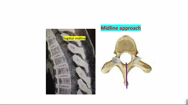 Thoracic epidural part one