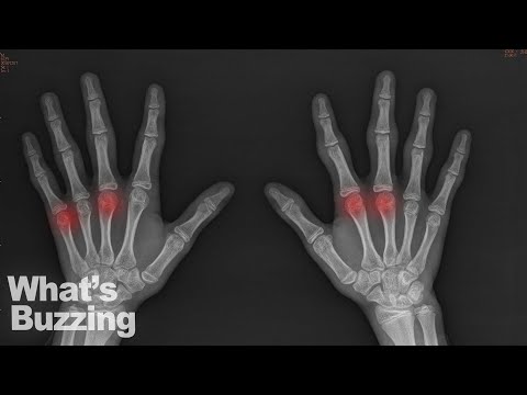 Video: Cracking Your Knuckles Tidak Menyebabkan Artritis