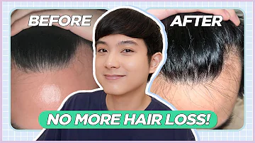 How I STOPPED My RECEDING HAIRLINE: My Hair Loss Treatment Journey (Filipino) | Jan Angelo
