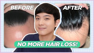 How I STOPPED My RECEDING HAIRLINE: My Hair Loss Treatment Journey (Filipino) | Jan Angelo