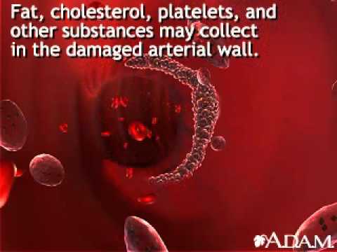 Video: Jinsi Ya Kuzuia Atherosclerosis