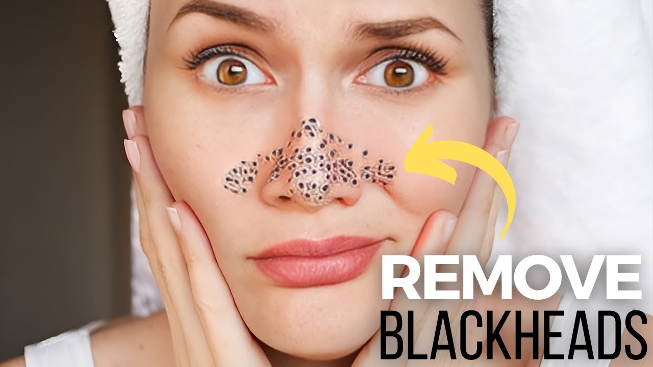 How To Get Rid Of Blackheads On Nose And Face YouTube