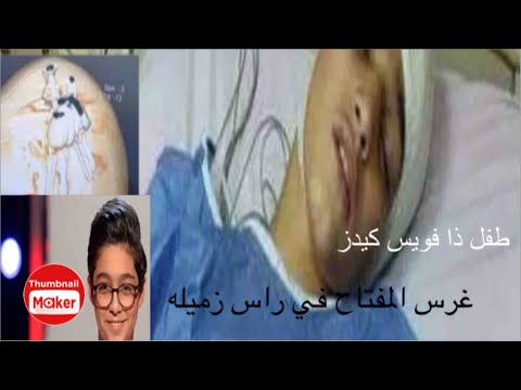 نجم ذا فويس كيدز معاذ عيسي هشم رأس زميله والسبب صادم