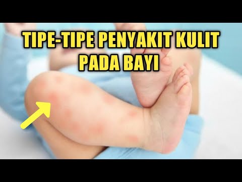 Macam-macam Penyakit Kulit Pada Bayi & Cara Penanganannya