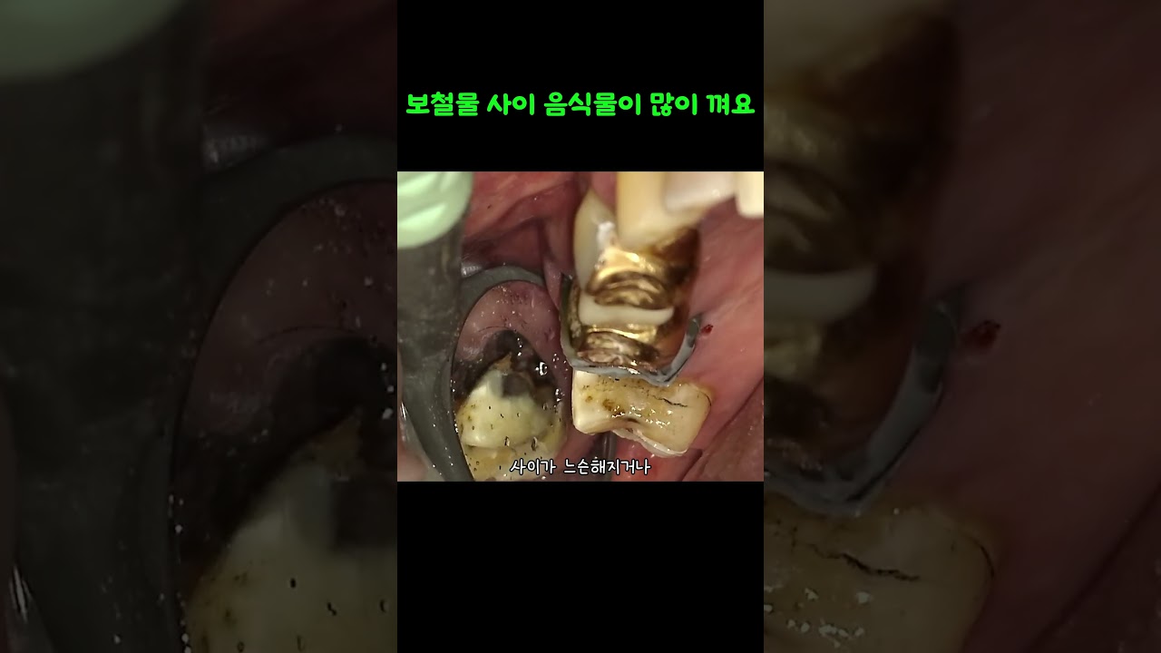 보철물 사이에 음식물이 껴요 #치과