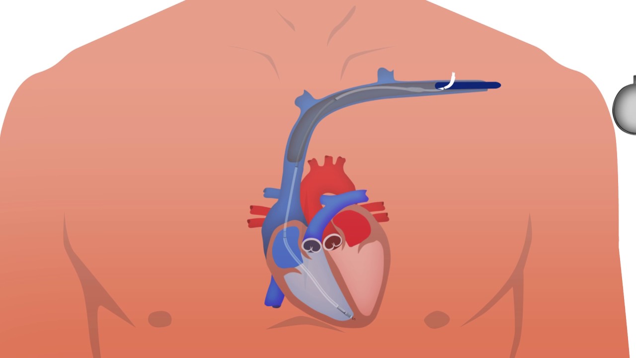 Défibrillateur automatique implantable – Institut de cardiologie