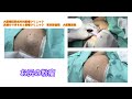 臀部の大きな粉瘤　ブログでも粉瘤について詳しく解説してます。東京皮膚のデキモノと粉瘤クリニック　ふるばやし形成外科　東京新宿院　大阪梅田形成外科クリニック
