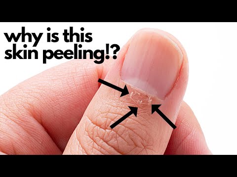 Cuticle Peeling After A Manicure