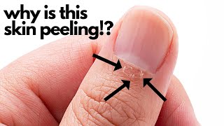 Cuticle Peeling After a Manicure?