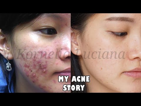 MY ACNE STORY |JERAWAT HILANG DALAM 2 MINGGU by Mawar ♥️. 