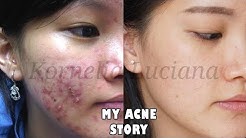 MY ACNE STORY - CARA MENGHILANGKAN JERAWAT SETELAH BERHENTI CREAM DOKTER - Durasi: 22.48. 