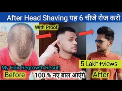 After Head Shaving यह 6चीजें रोज करो नए बाल आएंगे|how to grow hair fast after head shaving|headshave