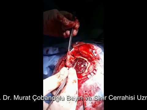 Kafa travması cerrahisi - Akut Subdural Hematom