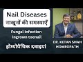 Nail Fungul infection onychomycosis Homeopathic permanent cure detail of medicines in Hindi Dr Ketan
