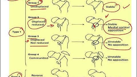 Inter trochanteric femur fracture classification