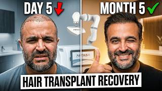 ARTAS Robotic FUE Recovery: What Happens Each Week and Month