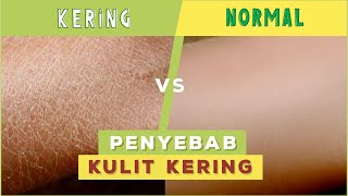 Ternyata Inilah Penyebab Kulit Kering !