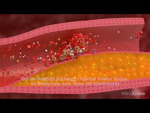 Video: Plasmocytoid Urotelcancer - Kliniska, Histologiska, Immunohistokemiska Och Molekylära Aspekter