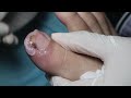 Ep_3594 Toenail removal 👣 ไม่ได้ชนอะไร..แผลค่อยๆใหญ่ขึ้นครับ 😷 (clip from Thailand)