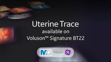 Uterine Trace – Voluson™ Signature BT22