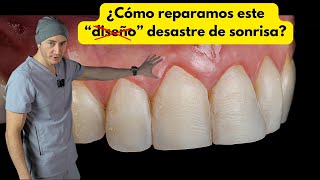 ¿Cómo reparar un DESASTRE de sonrisa? | El verdadero diseño de sonrisa by Dr. Federico Baena Q 29,765 views 1 month ago 12 minutes, 58 seconds