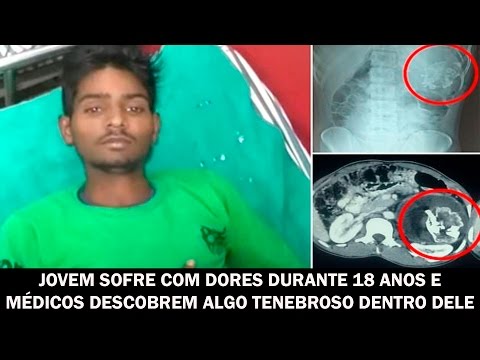 Vídeo: Dentro De Um Adolescente De 15 Anos, Seu Irmão Parasita Foi Encontrado Com Cabeça, Pernas E órgãos Genitais - Visão Alternativa