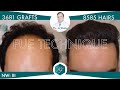 Injerto Capilar Técnica FUE – 3.681 Grafts (8.585 Pelos) – Dr. Rafael de Freitas.