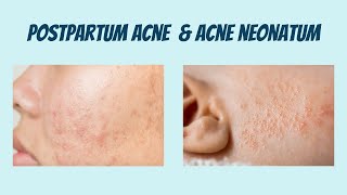 Postpartum acne & acne neonatorum while breastfeeding (Use your own breast milk)