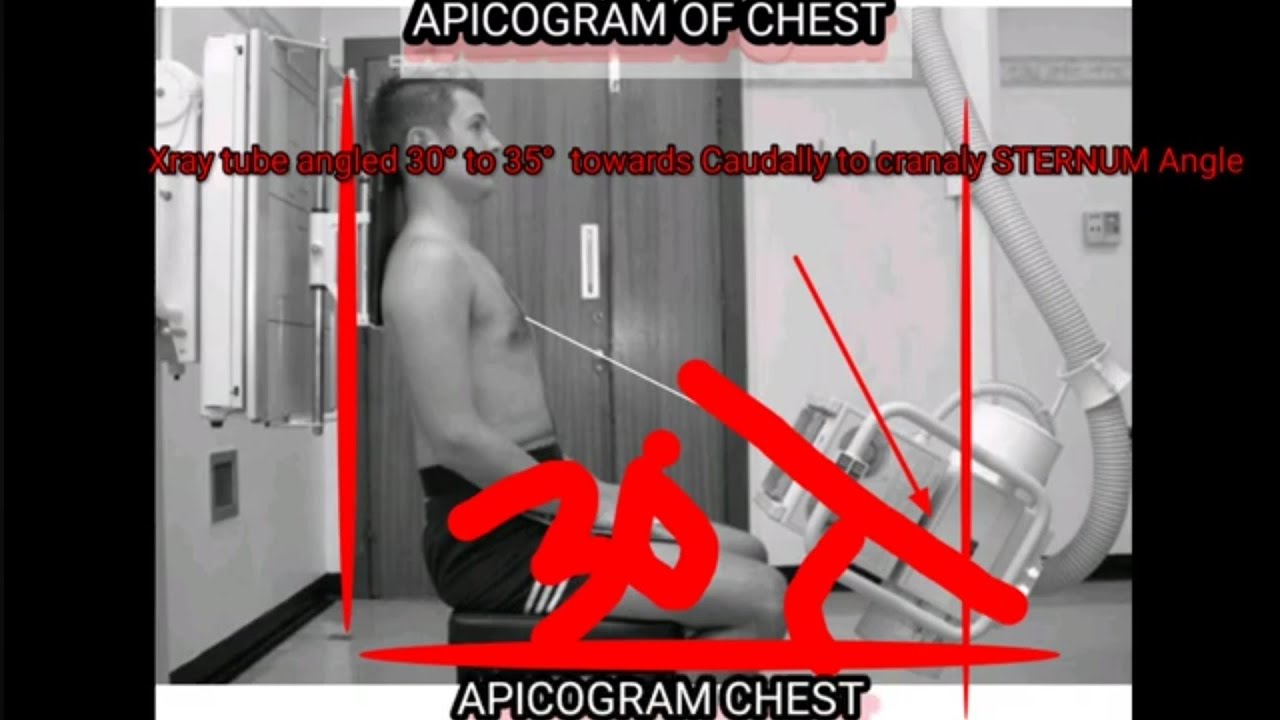 CHEST XRAY APICOGRAM How to do chest APICOGRAM #chestxray #radiology # ...