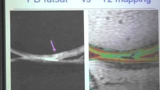 MRI of Articular Cartilage by Steven Meyers, MD