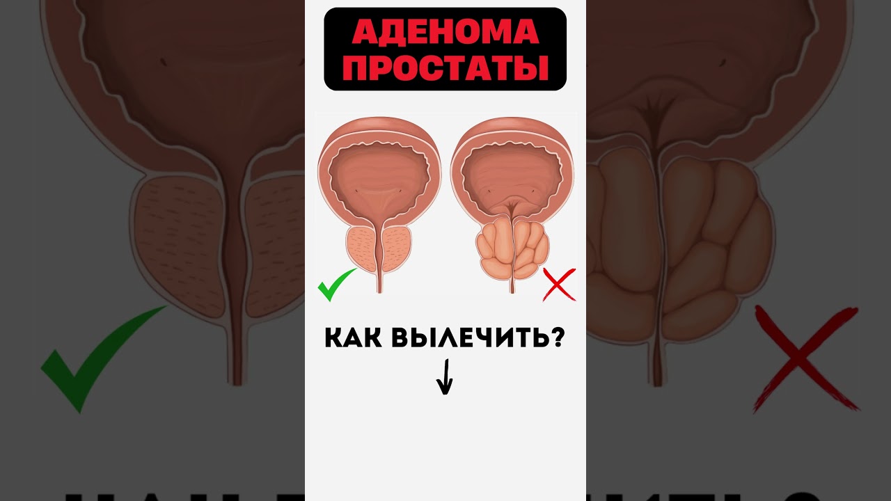 АДЕНОМА ПРОСТАТЫ 👉 Решение проблемы ДГПЖ #меднавигатор #аденома #простата
