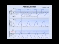 Ventilator Modes (Mechanical Ventilation - Lecture 7)