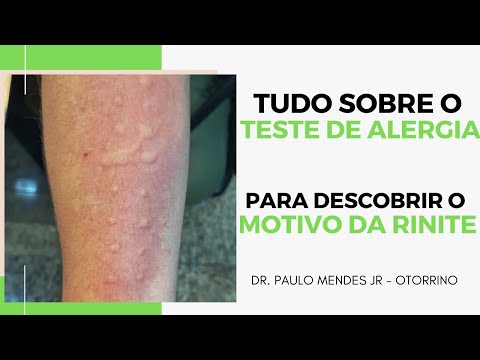 Vídeo: Como fazer o teste para alergias: 15 etapas (com fotos)