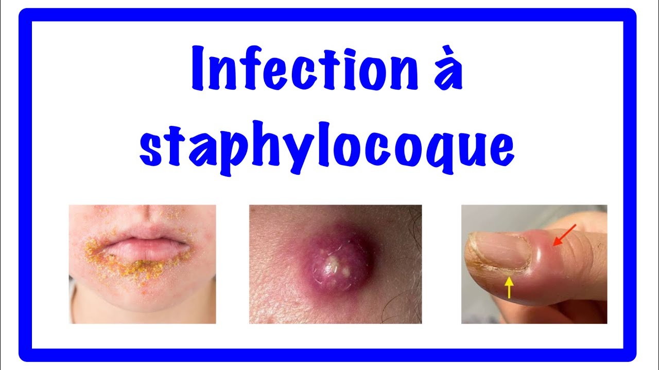🔵les infections a staphylocoque